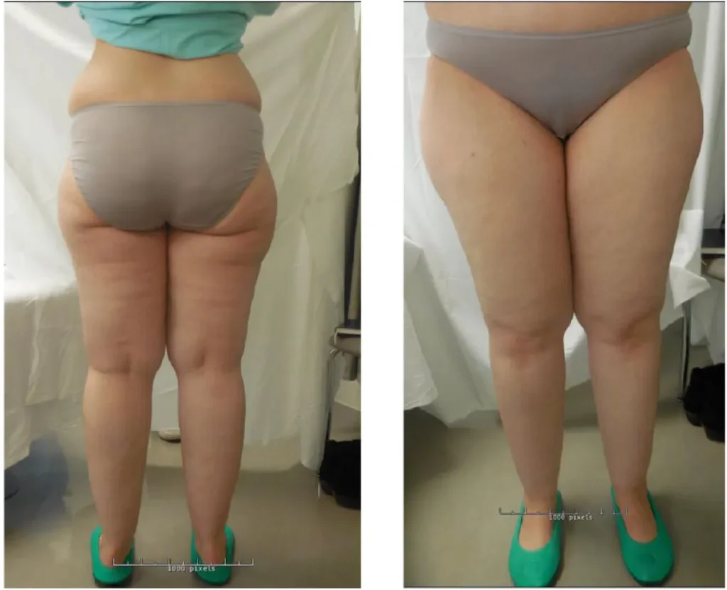 Lipedema surgery covered by insurance