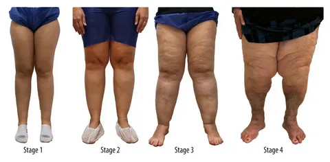 Lipedema surgery covered by insurance